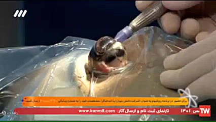 ببینید | جراحی چشم روی آنتن تلویزیون برداشتن خال