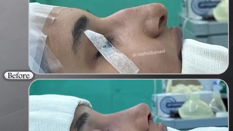 قبل و بعد از جراحی بینی قوزدار با افتادگی نوک بینی