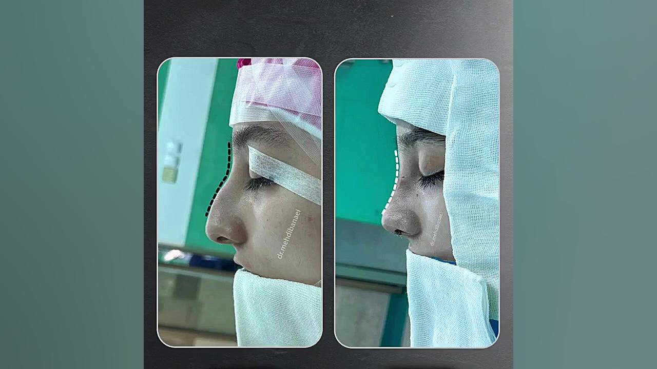 جراحی زیبایی بینی با قوز شدید