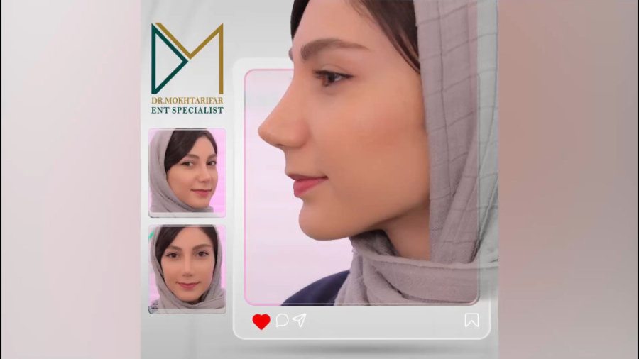 جراحی طبیعی بینی بعد از سه ماه و نیم | دکتر فاطمه مختاری فر دکتر فاطمه مختاری فر جراح بینی در لرستان