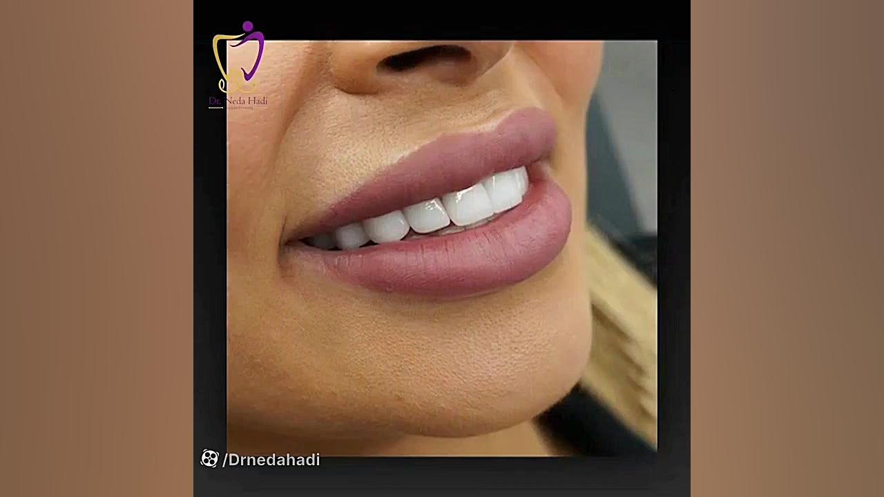 نمونه کار اصلاح طرح لبخند دکتر ندا هادی-دندانپزشک زیبایی