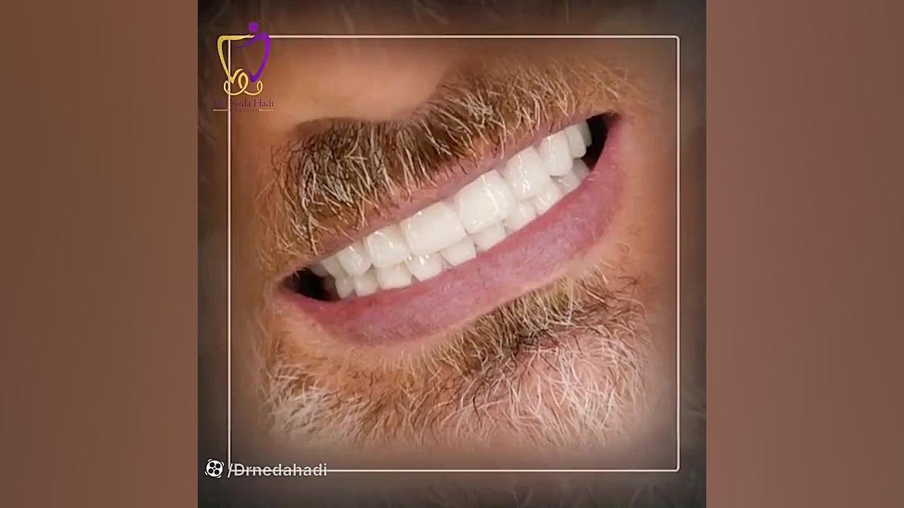 فیلم جذاب و جدید درباره اصلاح طرح لبخند با کامپوزیت دندان دکتر ندا هادی-دندانپزشک زیبایی