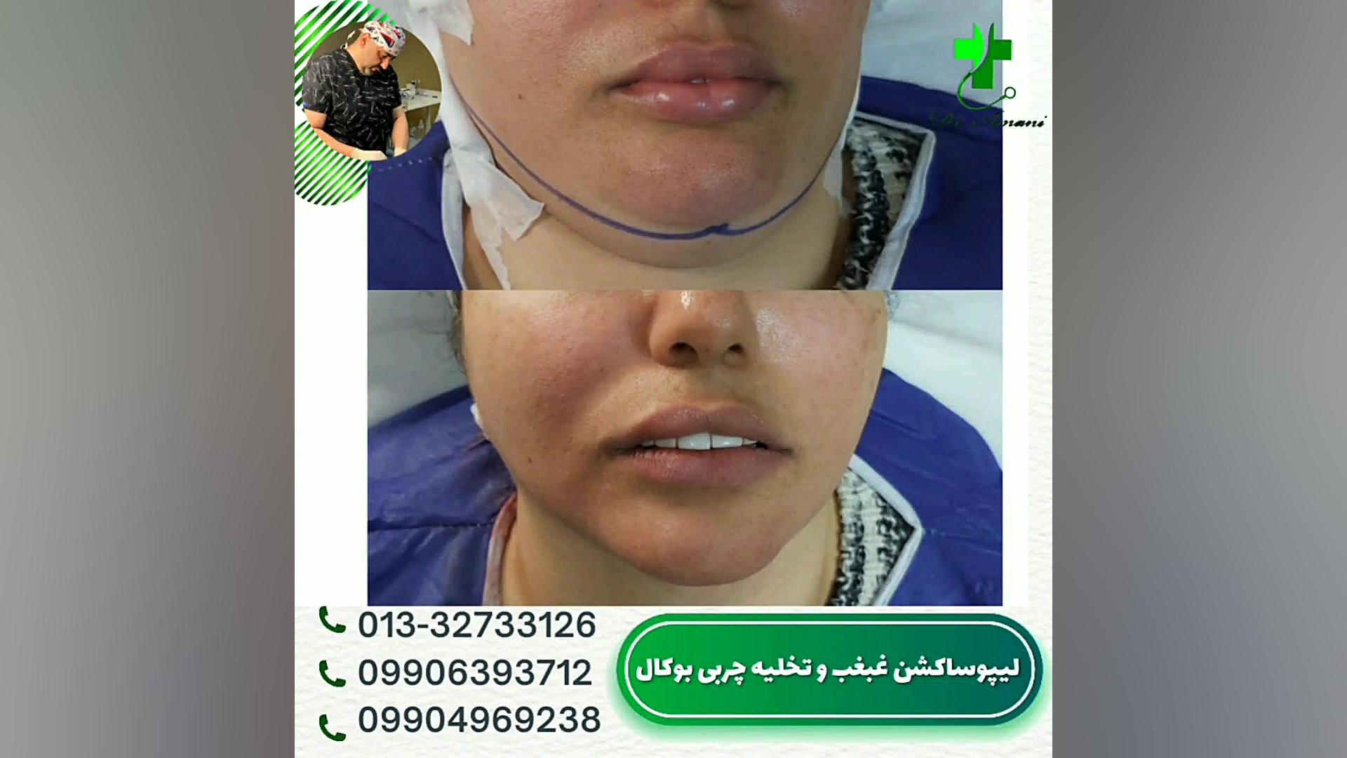 لیپوساکشن غبغب و جراحی بوکال فت لیزر کوانتومی جراحی چشم