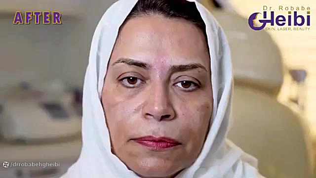 تزریق فیلر خط اخم دکتر ربابه غیبی