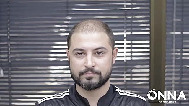 فروش عمده پروتز مو در رنگبندی و مدل های مختلف 09198858620