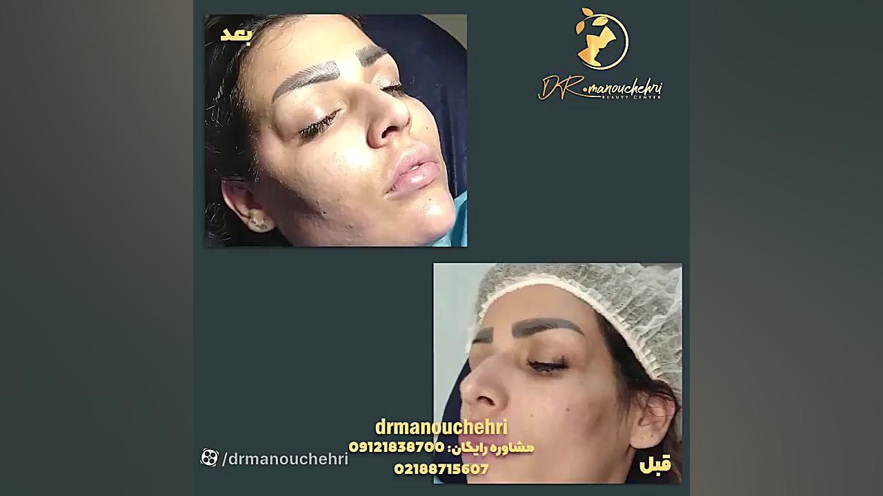 تزریق چربی و زاویه سازی صورت بروش نانوفت | دکتر منوچهری Northern Blot
