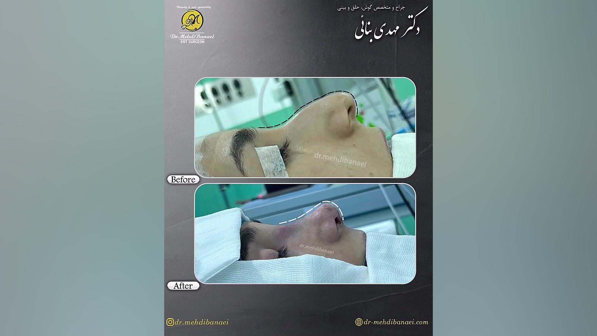 جراحی بینی با قوز شدید