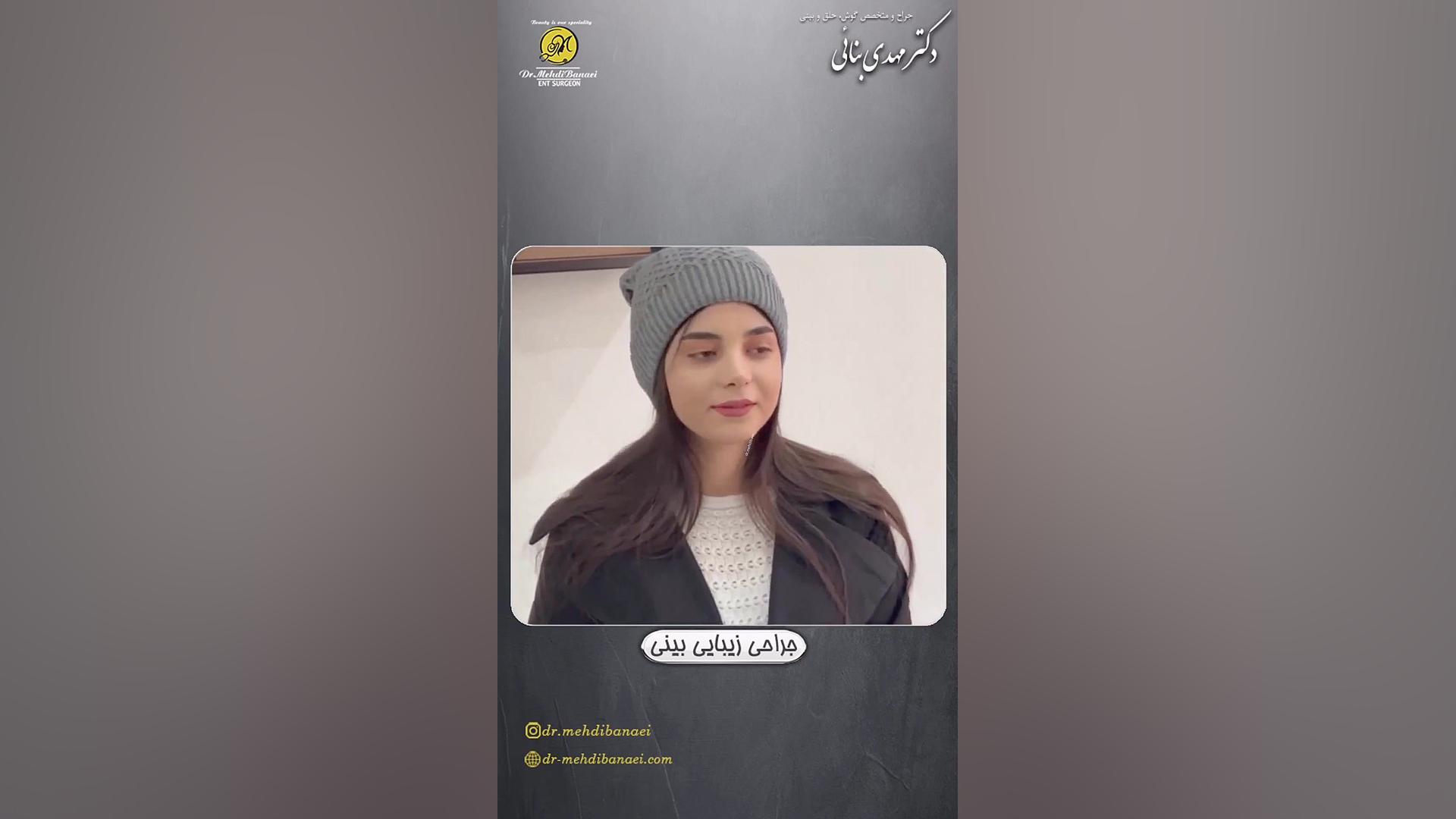 4ماه پس از جراحی زیبایی بینی