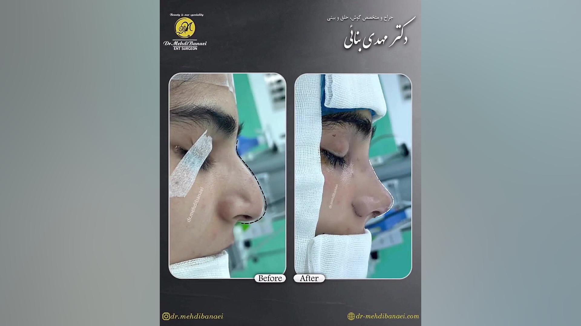 جراحی زیبایی بینی
