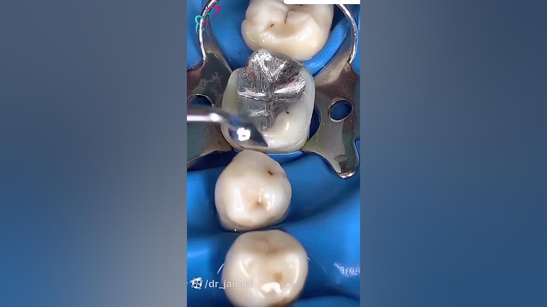 پر کردن دندان رانولازین