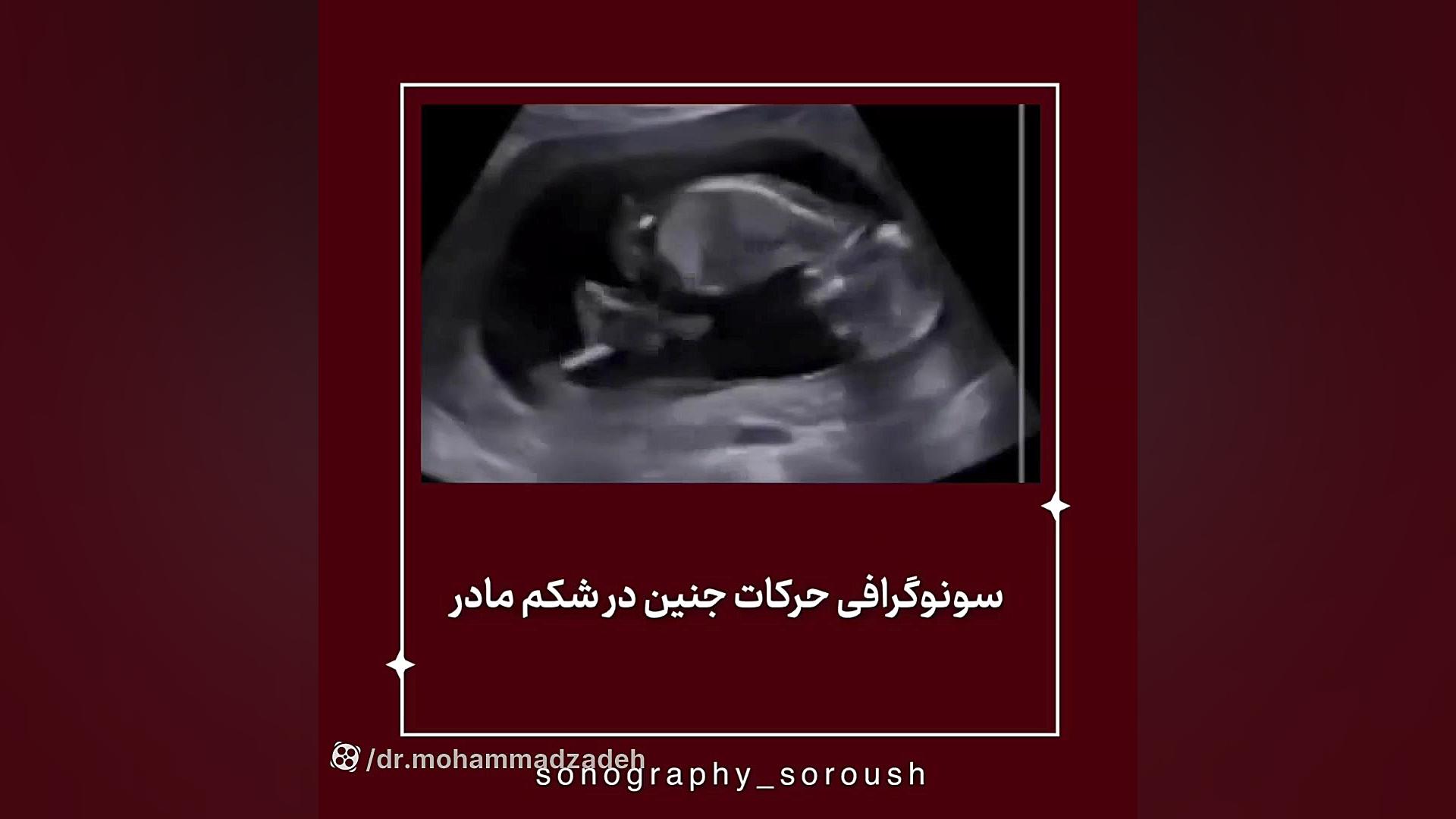 سونوگرافی حرکات جنین در شکم مادر لیزر صورت