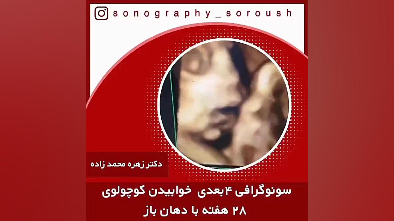 سونوگرافی چهار بعدی خوابیدن کوچولوی ۲۸ هفته با دهان باز گل گدوت