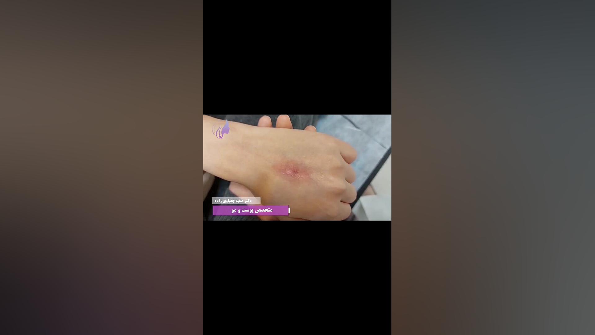 رفع اسکار سوختگی با لیزر pdl دکتر صفیه چعباوی زاده