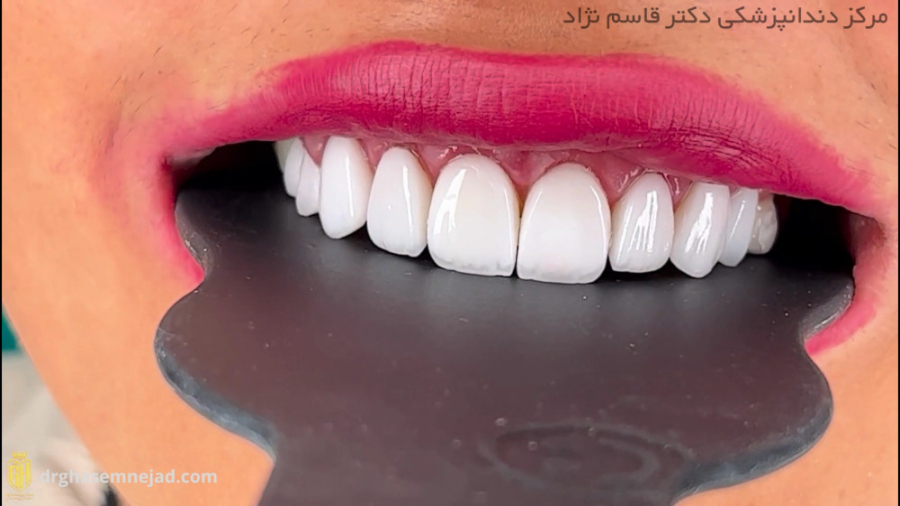 لمینت لبه شیشه ای دندانپزشکی زیبایی دکتر قاسم نژاد
