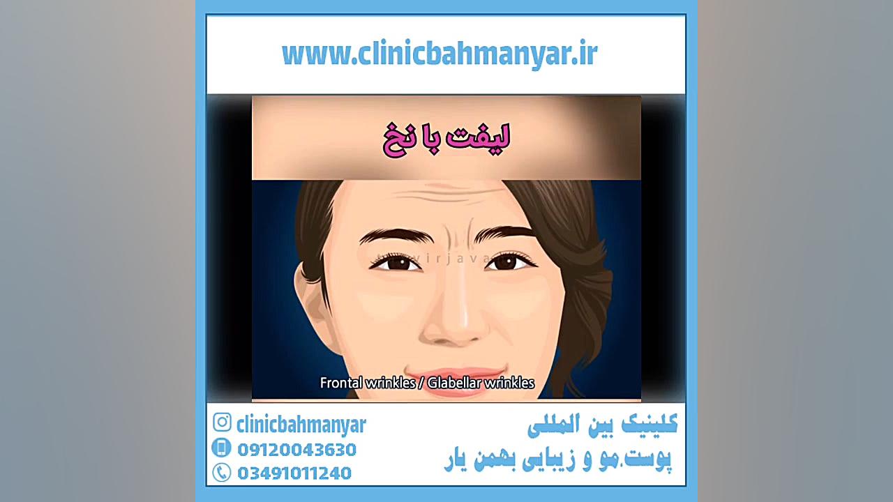 ماندگاری لیفت با نخ صورت اصلاح فرم صورت
