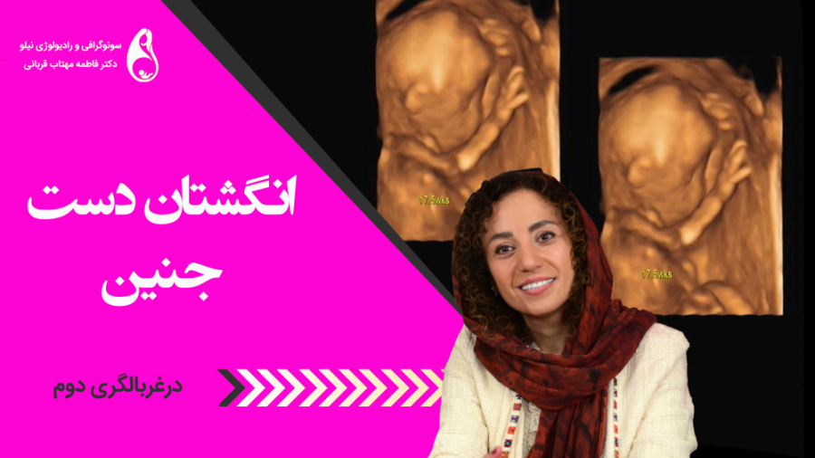 انگشت جنین سونوگرافی نیلو دکتر فاطمه مهتاب قربانی