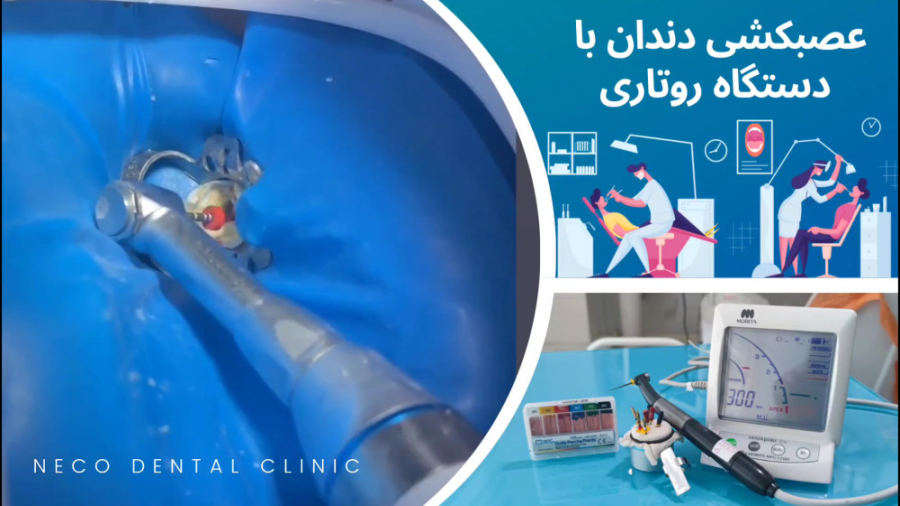 عصبکشی دندان یا درمان ریشه با دستگاه روتاری کلونیک اسپاسم
