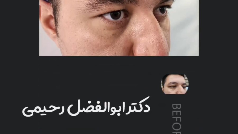 عمل لیفت ابرو و پلک ببینید! بیولوژی پرتوی