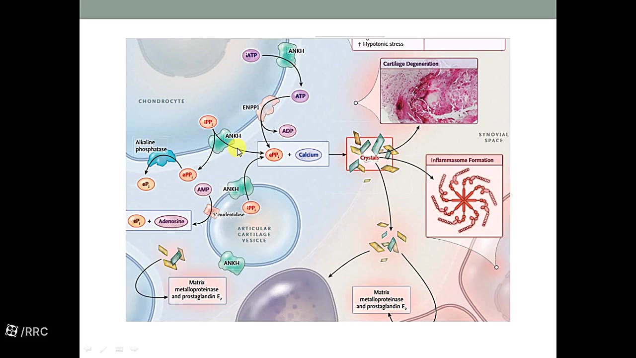 Calcium Crystal Disease Calcium Pyrophosphate Dihydrate Basic Calcium Phosphate منافذ باز پوست