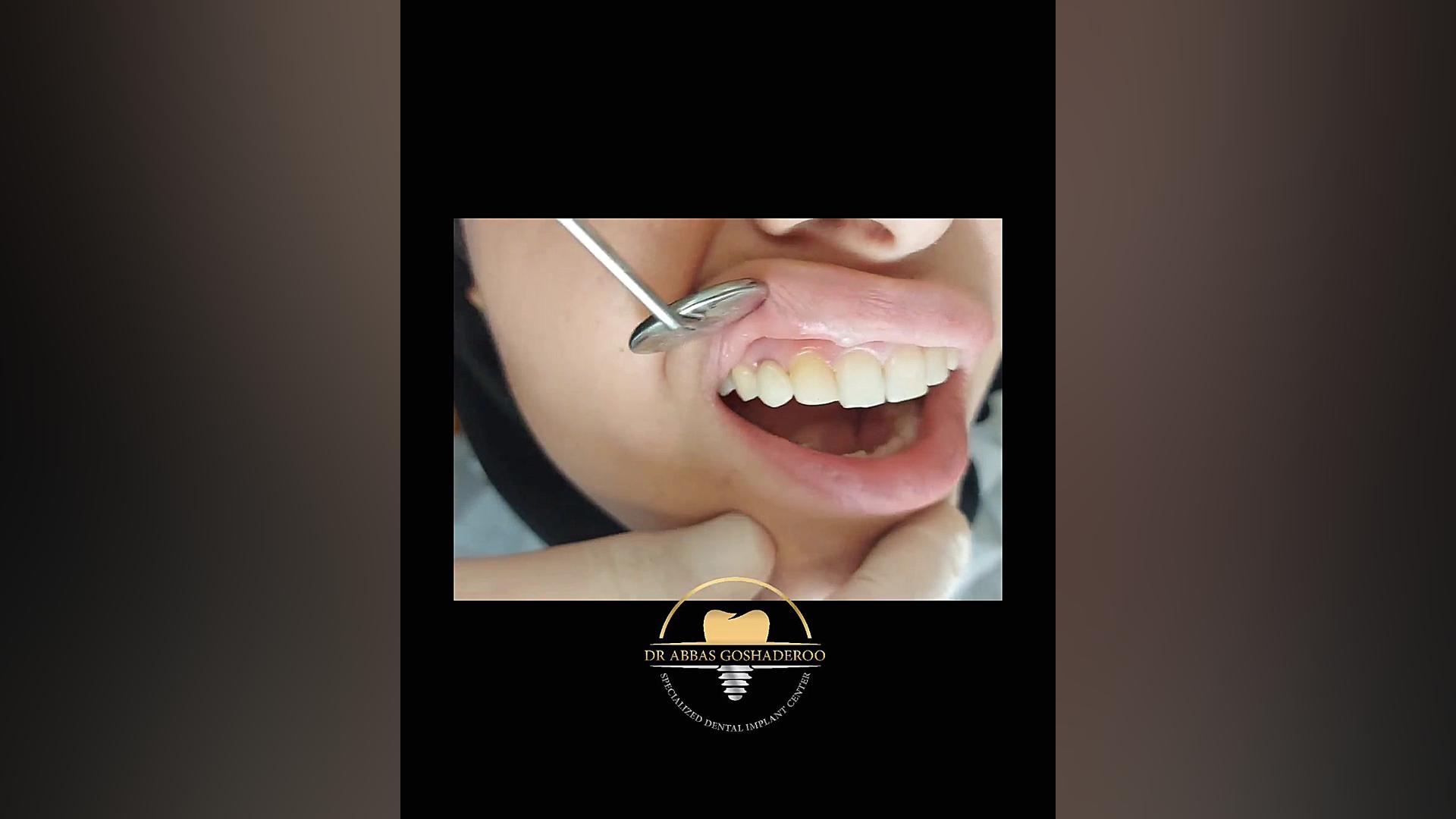 اصلاح لبخند با کاشت یک واحد ایمپلنت و روکش تمام سرامیک(زیرکونیا) لکوپنی شدید