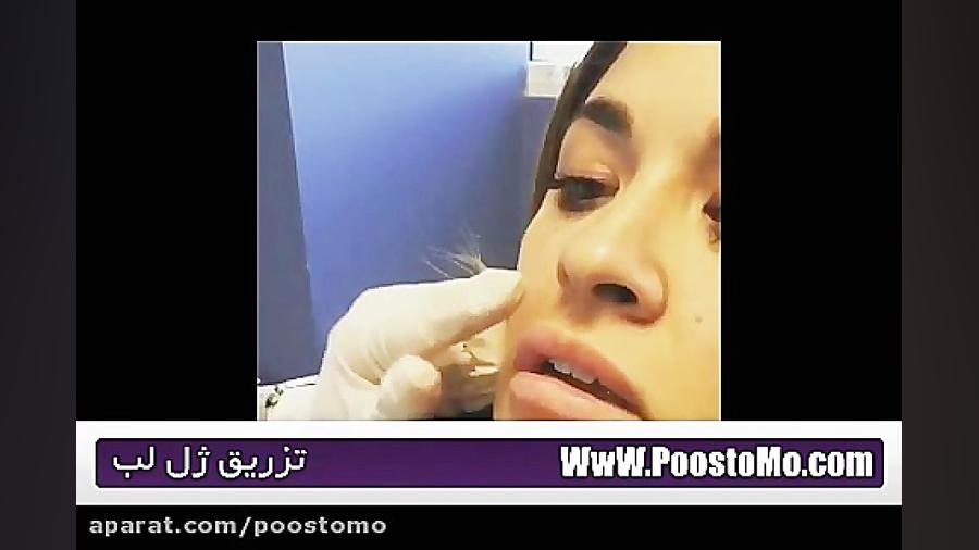 تزریق ژل لب - پروتز لب FEV1