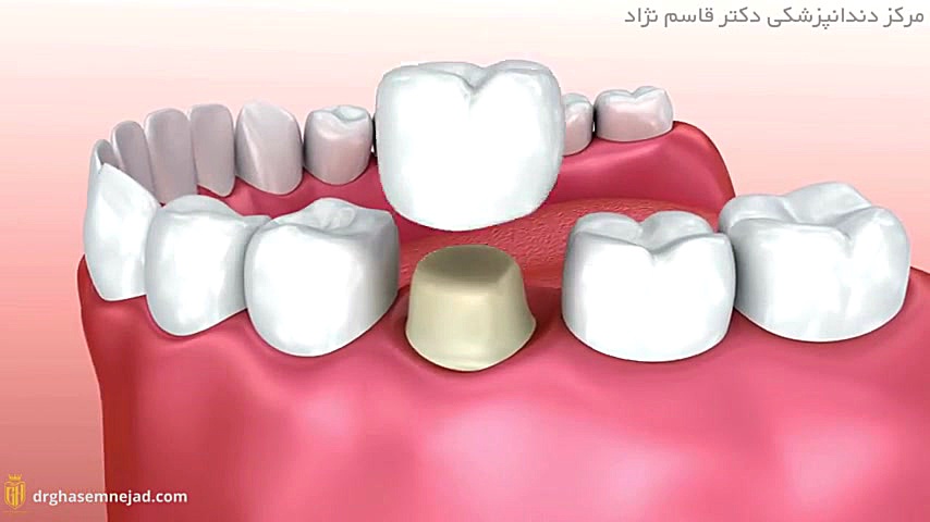 روکش دندان دندانپزشکی زیبایی دکتر قاسم نژاد