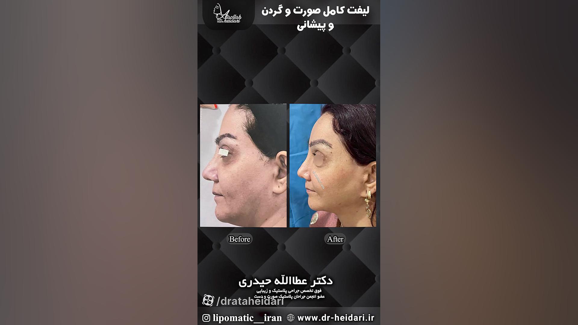 لیفت آندوسکوپی صورت ، گردن و پیشانی و بلفاروپلاستی تحتانی پروتز سینه