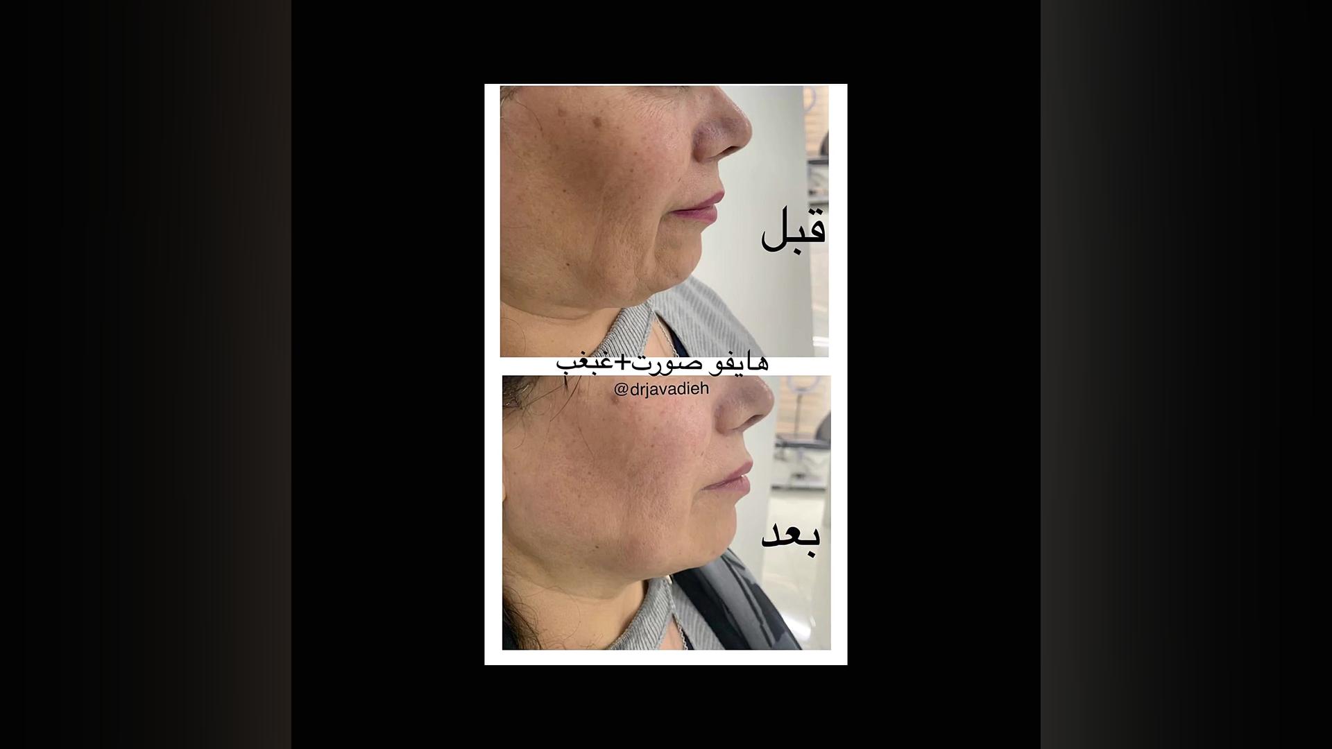 هایفوتراپی و لیفت پوست HiChIP
