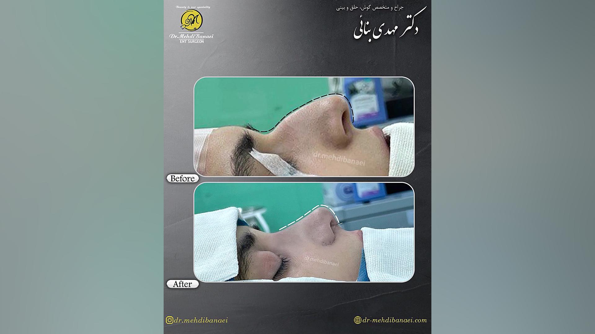 قبل و بعد از جراحی بینی قوزدار