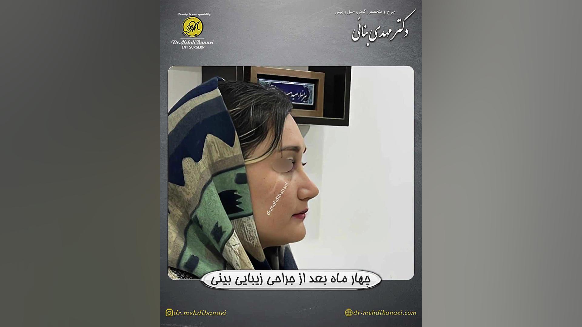چهار ماه بعد از جراحی زیبایی بینی