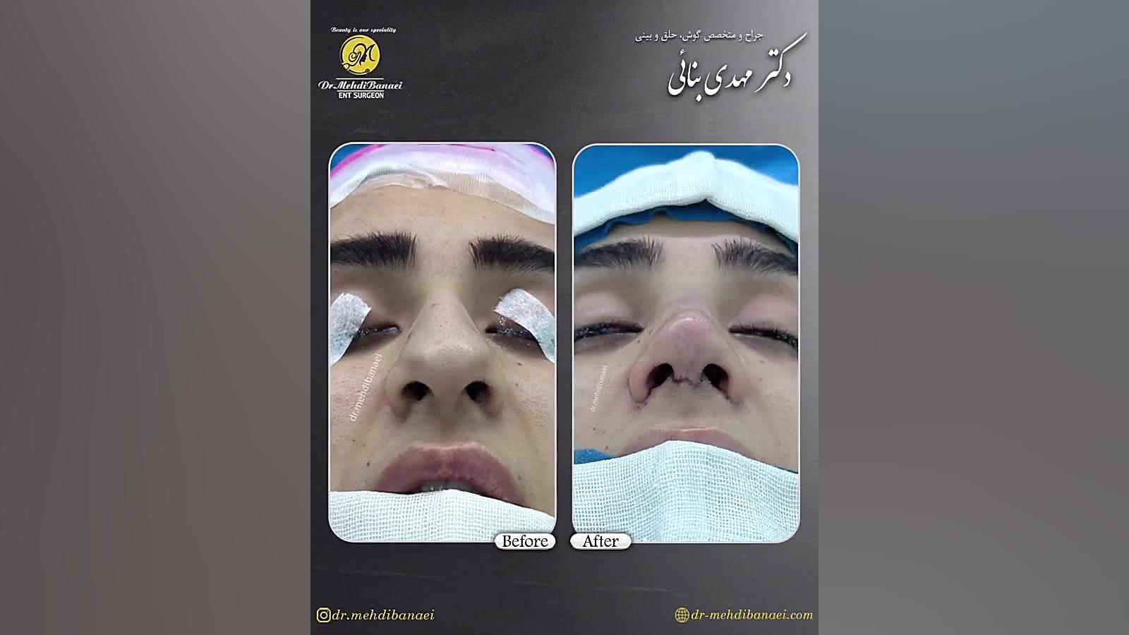 جراحی بینی گوشتی