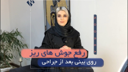 رفع جوش های ریز روی بینی بعد از جراحی بینی رفع جوش های ریز روی بینی بعد از جراحی بینی