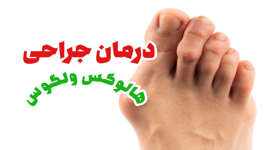 هالوکس والگوس (جراحی توسط دکتر سید وحید مروجی متخصص ارتوپدی و استخوان) اصلاح طرح لبخند