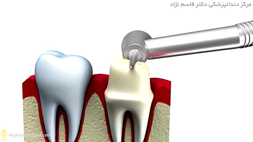 روکش دندان دندانپزشکی زیبایی دکتر قاسم نژاد