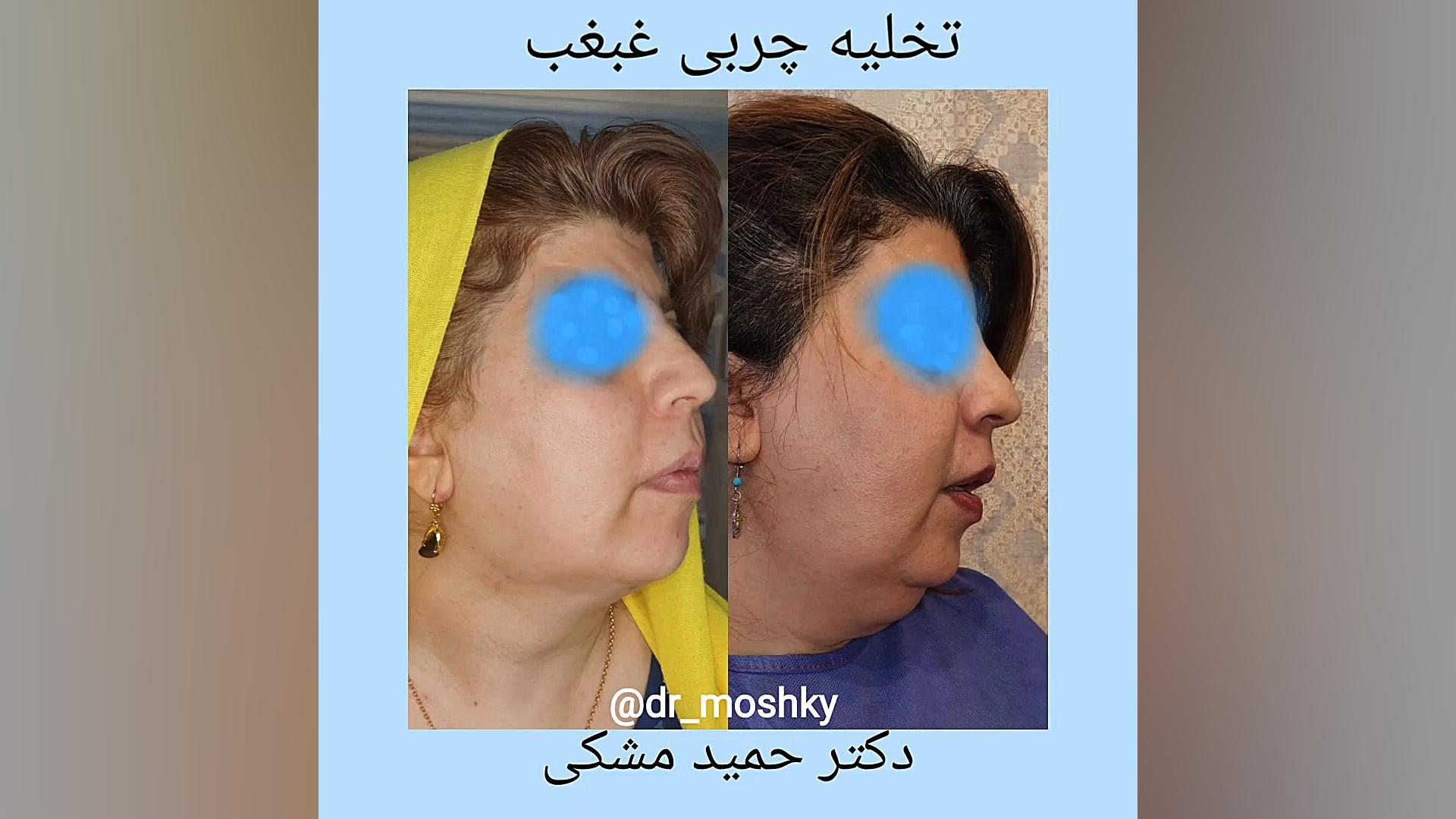 لیپوساکشن غبغب شکر پنیر