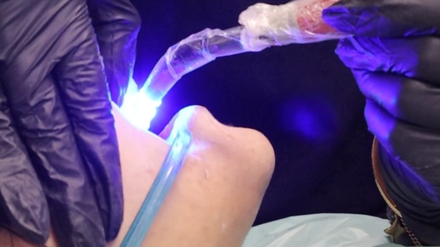 مراحل انجام کامپوزیت دندان توسط دکتر قاسم قاسم نژاد دندانپزشکی زیبایی دکتر قاسم نژاد