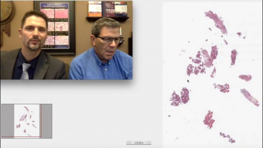 Pleural mesothelioma پاتولوژی مزوتلیوما درمان جای جوش