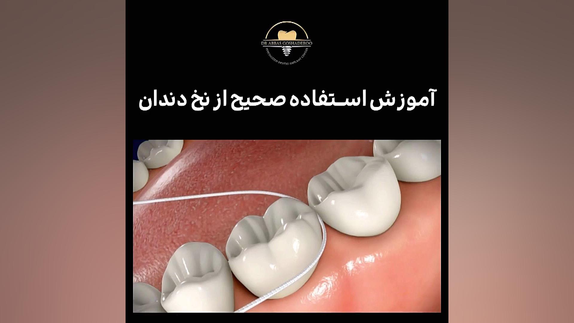 آموزش استفاده صحیح از نخ دندان برای بهداشت صحیح دهان و دندان دکتر عباس گشاده رو، متخصص جراحی لثه و ایمپلنت