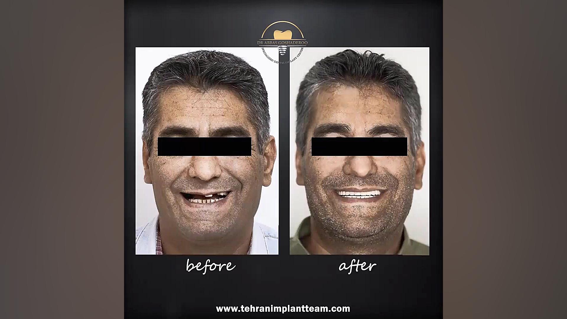 طراحی و بازسازی لبخند با ایمپلنت دندانی و روکش زیرکونیا دکتر عباس گشاده رو، متخصص جراحی لثه و ایمپلنت