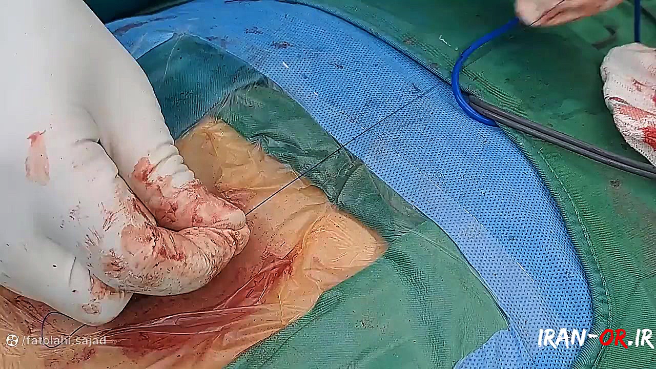 آموزش فیکس درن هموواک روی بیمار بهنام بانی