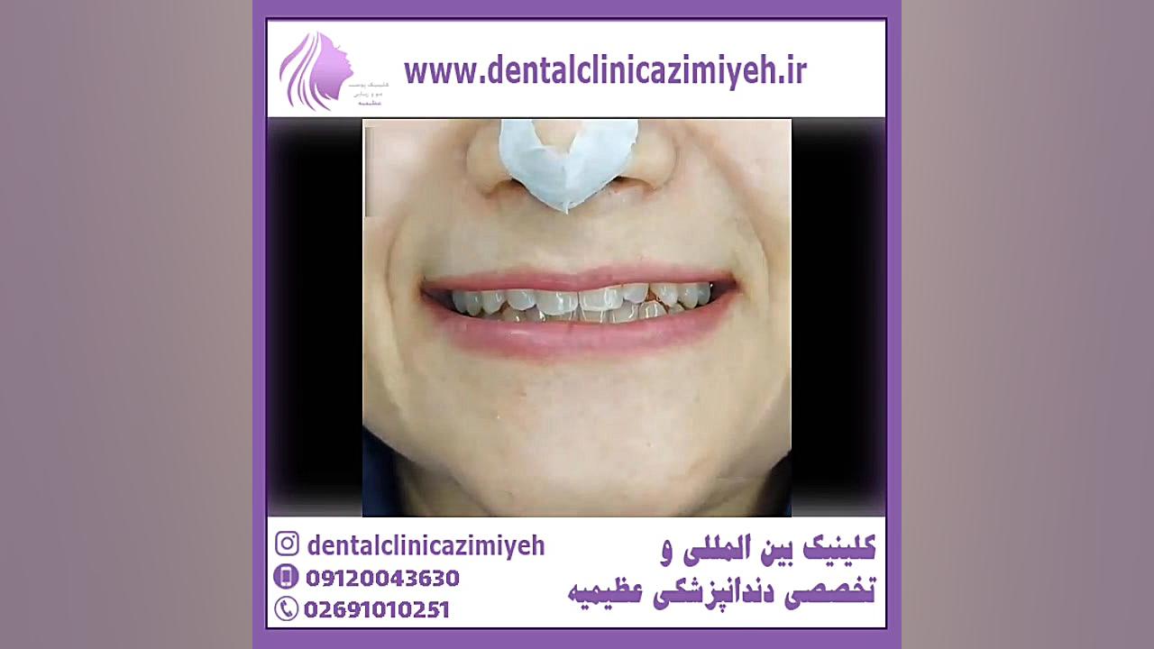 بهترین دکتر برای کامپوزیت ونیر دستگاه لیزر پالس فمتوثانیه