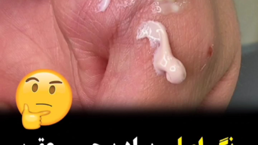 رنگ اصلی پماد بی حسی عقرب رفع چین و چروک