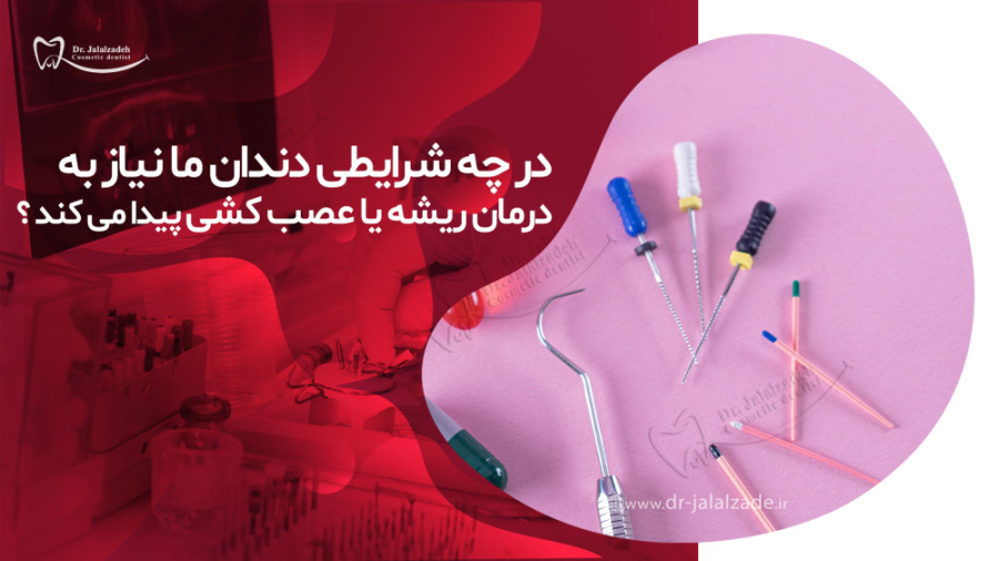 در مورد عصب کشی یا درمان ریشه بیشتر بدانید دکتر مرضیه جلال زاده