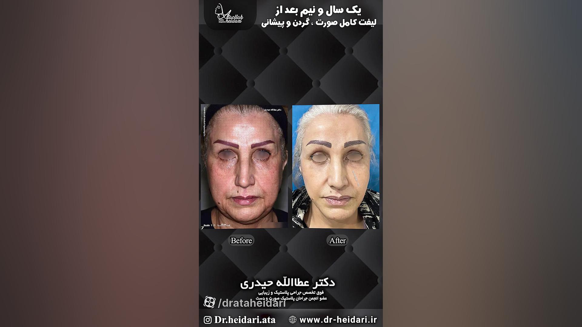 یکسال و نیم بعد از لیفت کامل صورت ، گردن و پیشانی درمان جای جوش