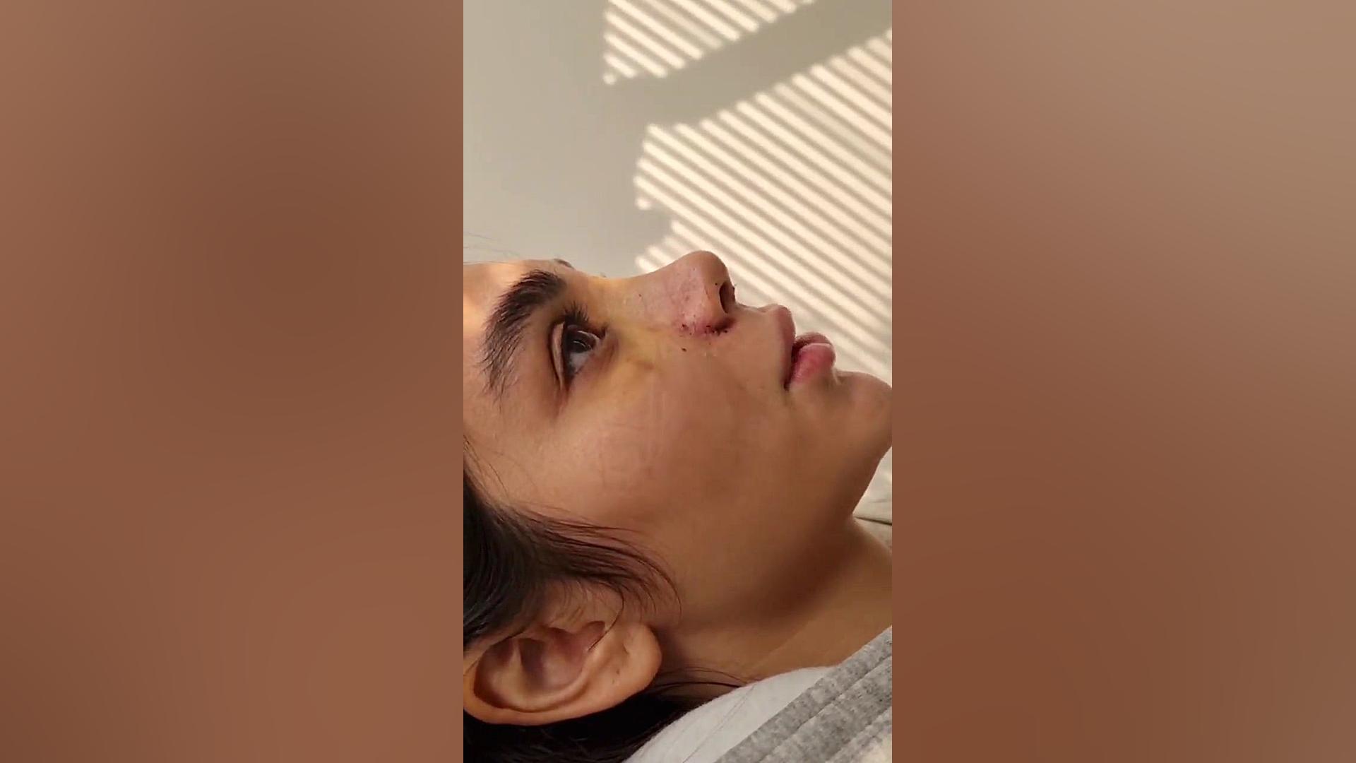جراحی زیبایی بینی دکتر مهرداد مقیمی - بینی نیمه فانتزی دکتر مهرداد مقیمی