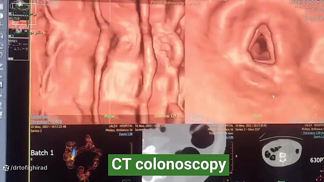 كولونوسكوپی CT کلینیک مو