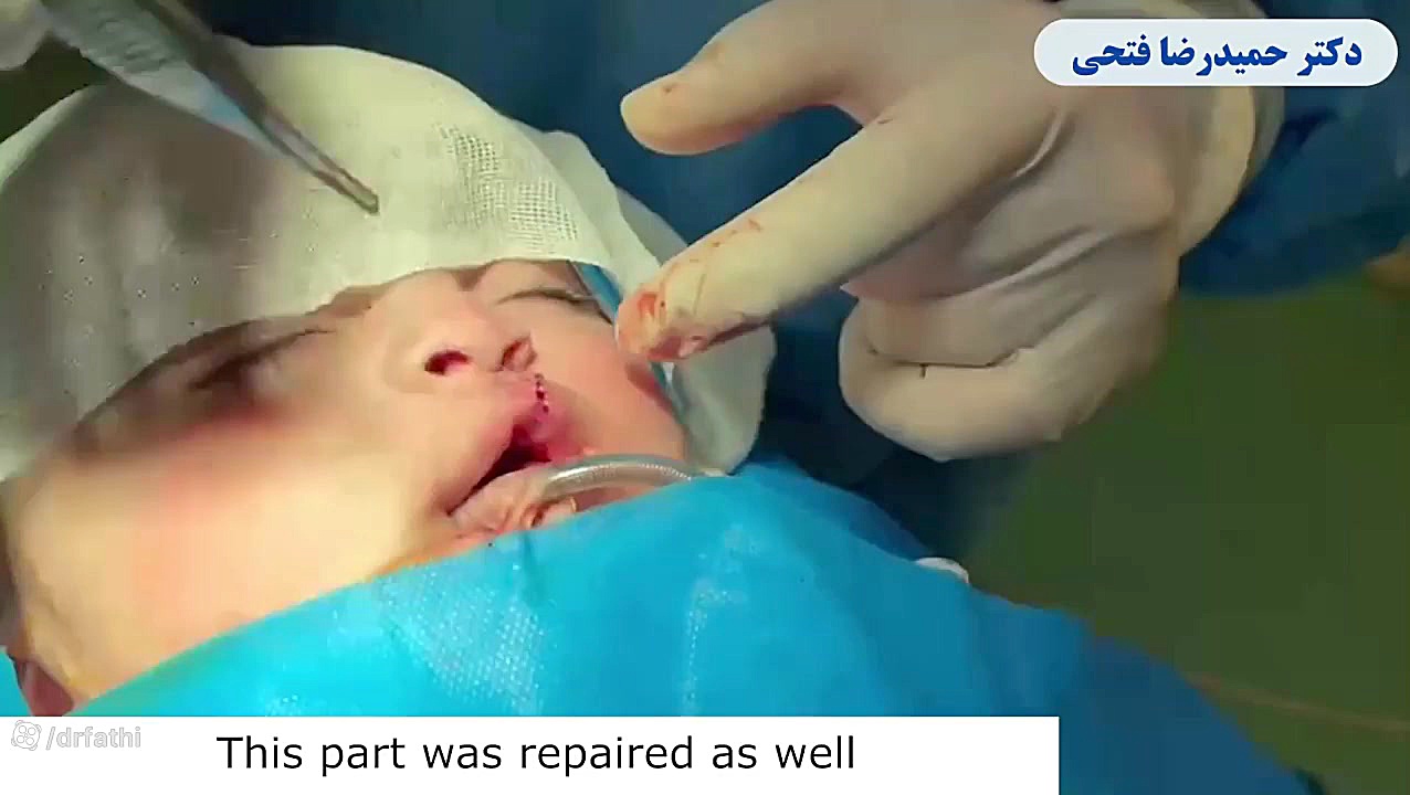 فیلم جراحی شکاف کام و لب کودک دکتر حمید رضا فتحی فوق تخصص جراحی پلاستیک