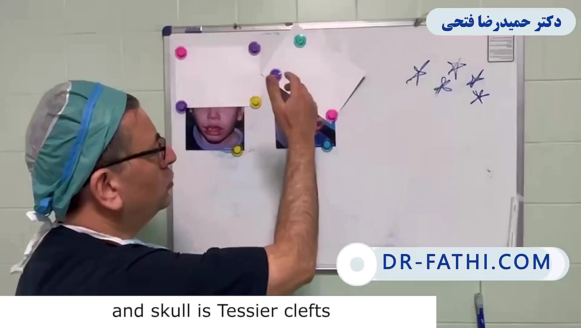 جراحی شکاف لب دکتر حمید رضا فتحی فوق تخصص جراحی پلاستیک