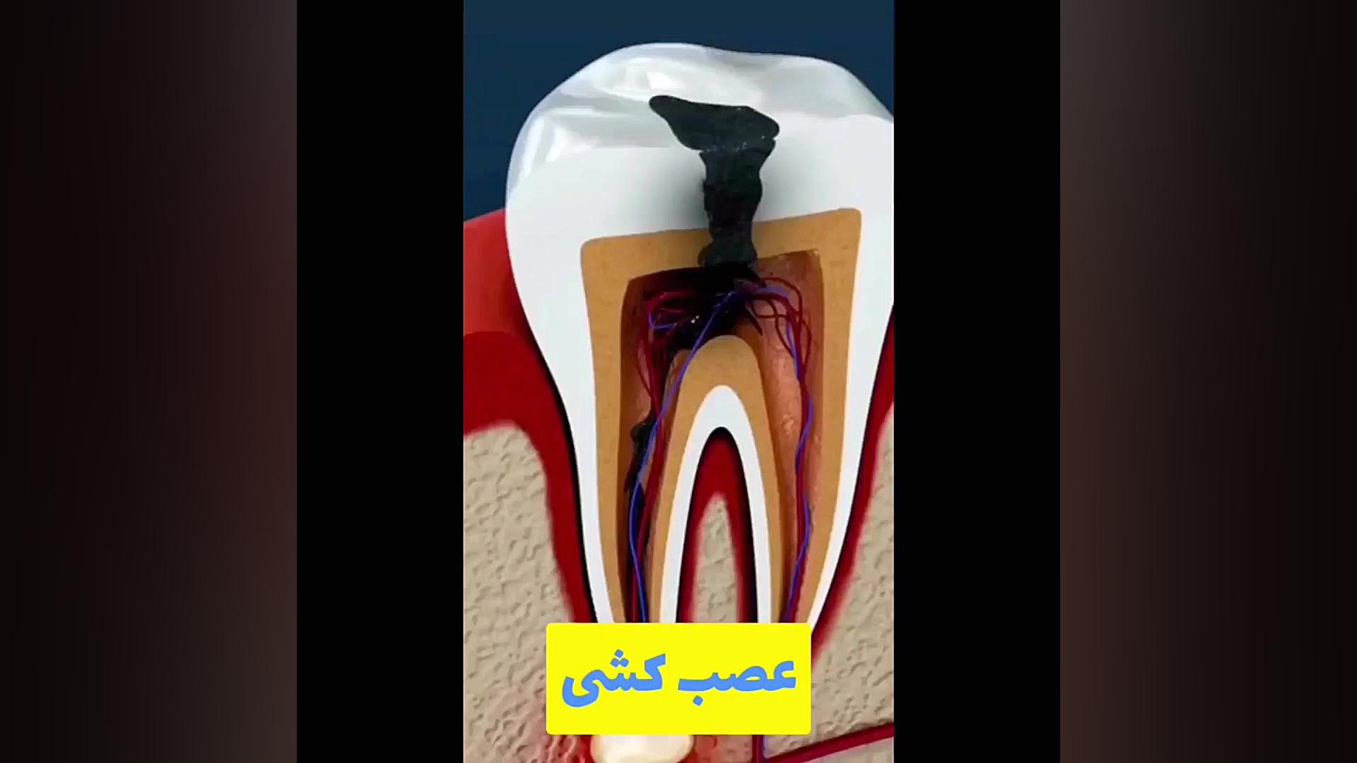 تا حالا عصب کشی رو دیدی؟ پلاسماجت