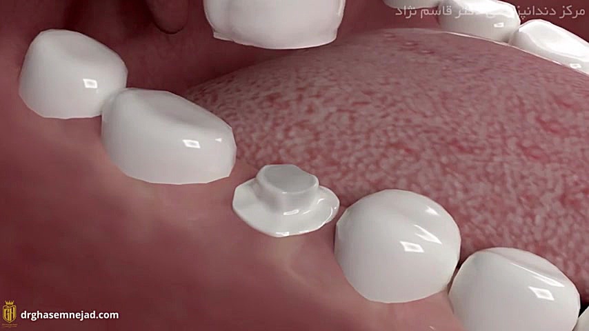 زیرکونیوم دندانپزشکی زیبایی دکتر قاسم نژاد